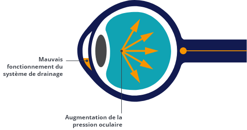 Glaucoma